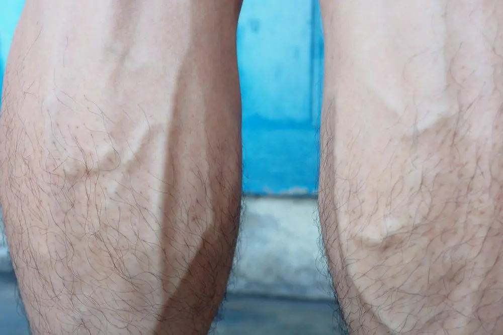 Popped veins in the legs