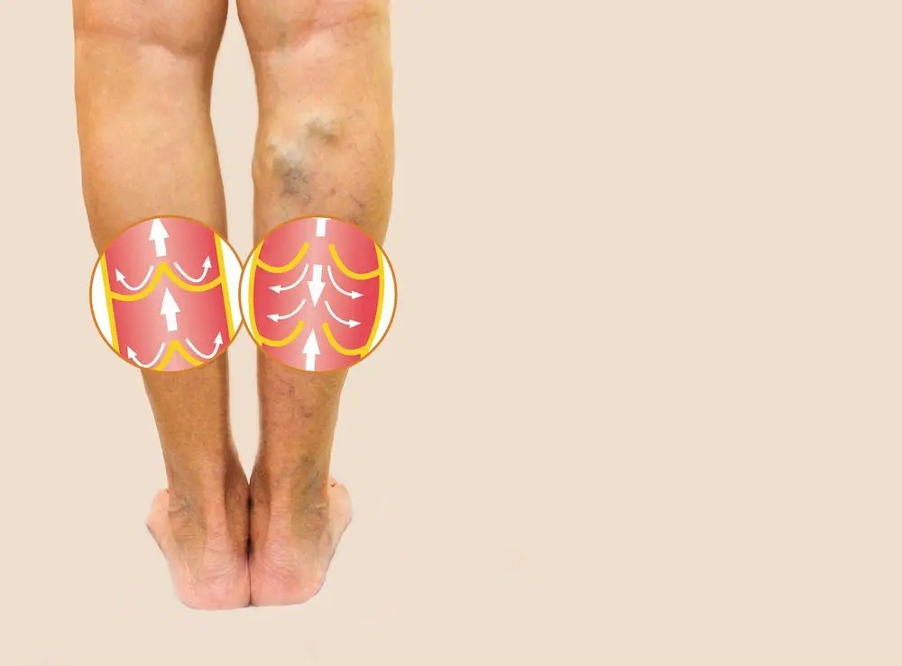 Read more about the article Varicose Veins Vs. Spider Veins: Symptoms & Treatment