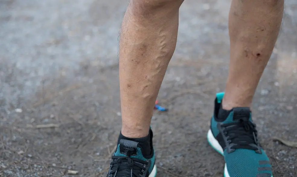 treating popped veins at a vein clinic in Illinois