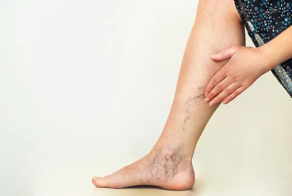 Varicose vein treatment options