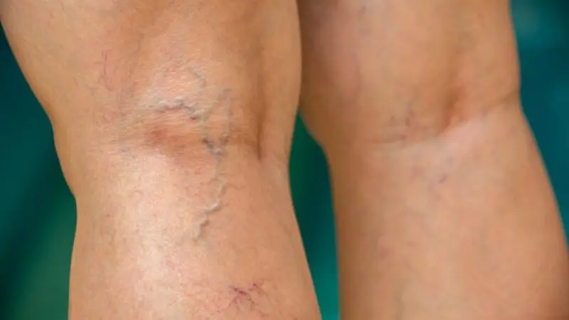 sudden prominent blue veins on legs