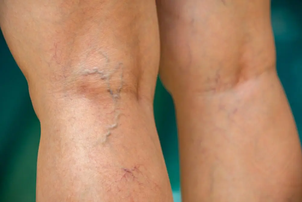 Read more about the article Blue Veins: What Causes Sudden Prominent Veins & How to Treat?