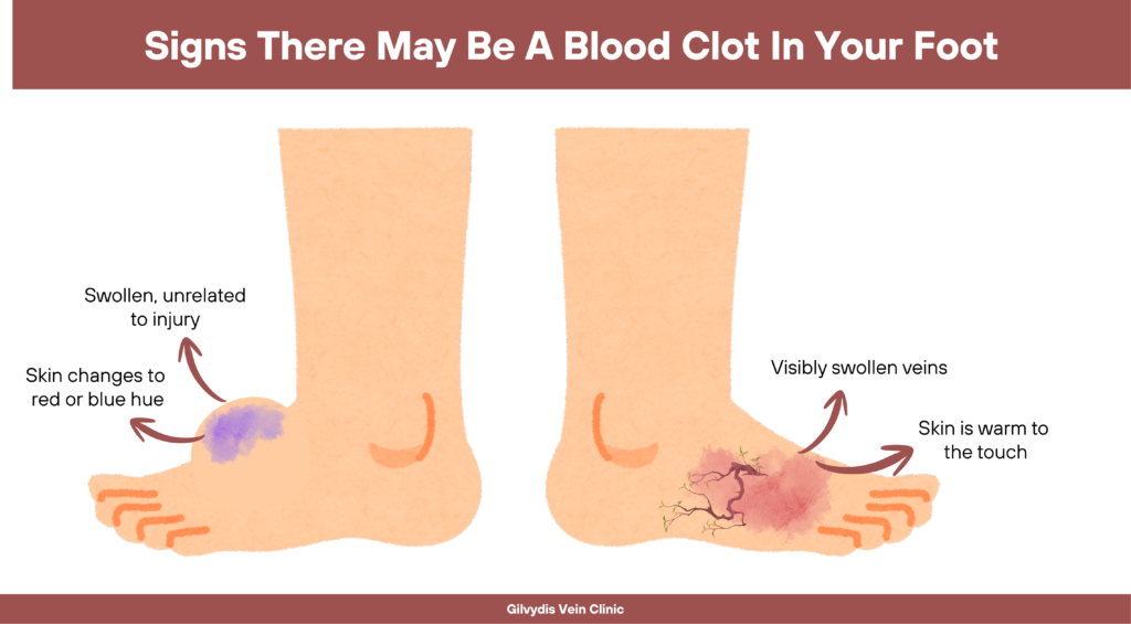 Blood Clot in foot symptoms