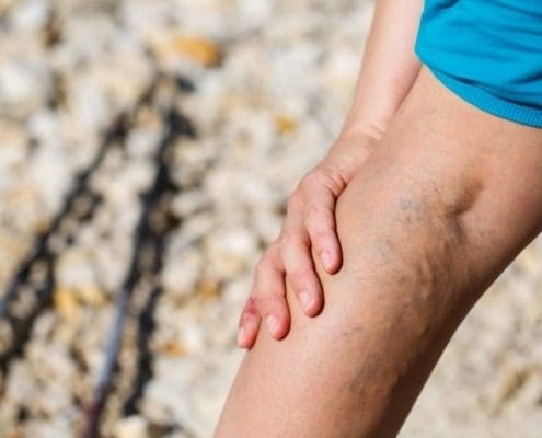 treating and removing large varicose veins