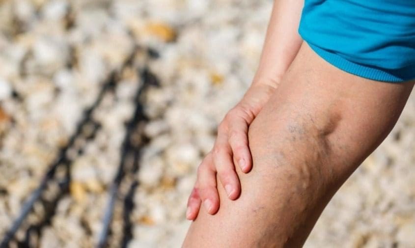 treating and removing large varicose veins