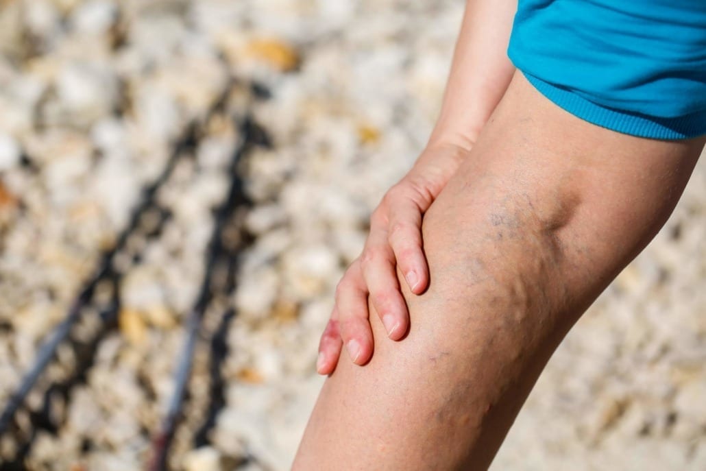 Read more about the article How to Remove and Treat Large Varicose Veins