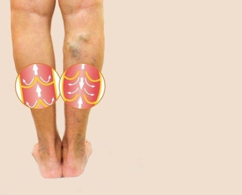 picioare balerina varicosa