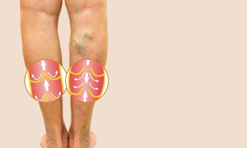 Varicose Veins vs. Spider Veins: The Difference | Gilvydis Vein Clinic