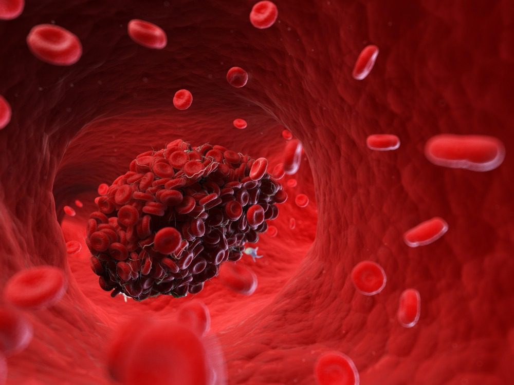 10 Ways To Identify A Dangerous Blood Clot Before Its Too 