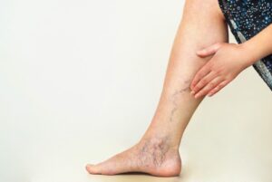 varicose veins in womens leg