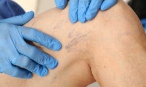 Close up of vein specialist working with patient with spider veins in legs