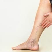 Varicose vein treatment options