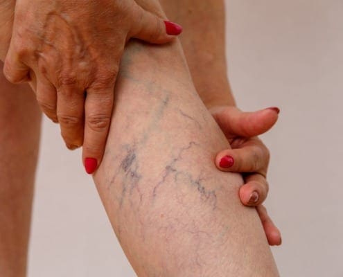 Women holding leg showing spider veins