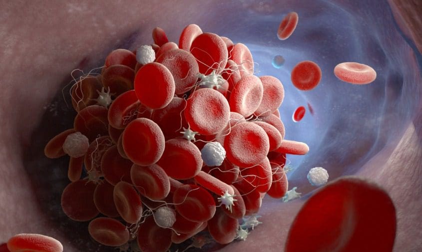 blood clot forming inside a blood vessel