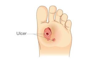 Foot ulcer diagram