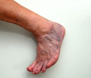 foot skin discoloration