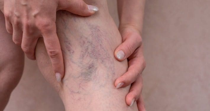 stages of Varicose veins