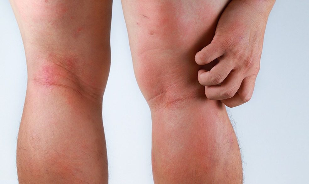 Read more about the article Do You Know Skin Conditions Can be Linked to Varicose Veins?