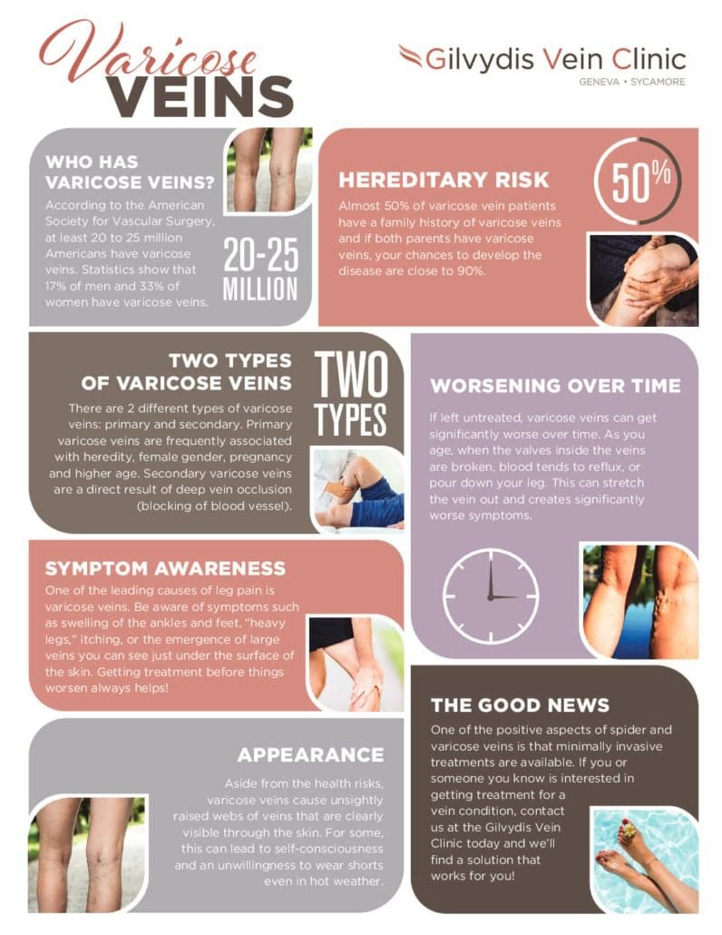 Gilvydis Vein Clinic varicose vein treatment infographic