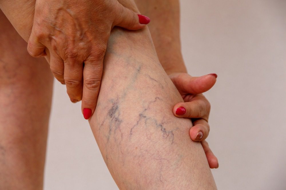 Treating Spider Veins With Sclerotherapy
