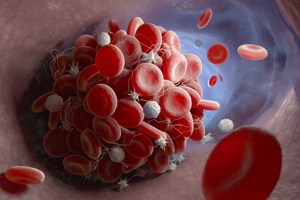 Read more about the article Blood Clots: What Are They and How To Prevent Them