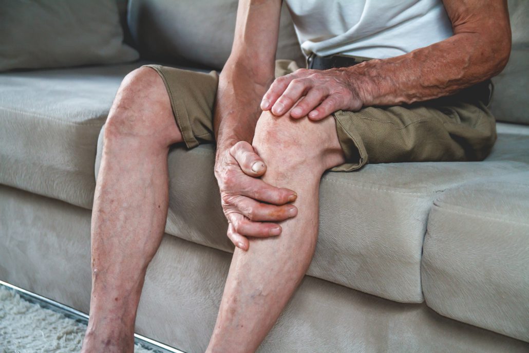 Read more about the article Varicose Vein Treatment For Men