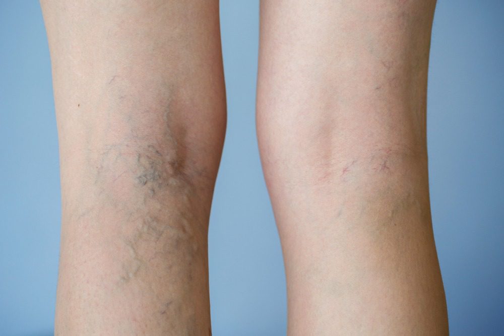 Signs & Treatments for Chronic Venous Insufficiency in Illinois