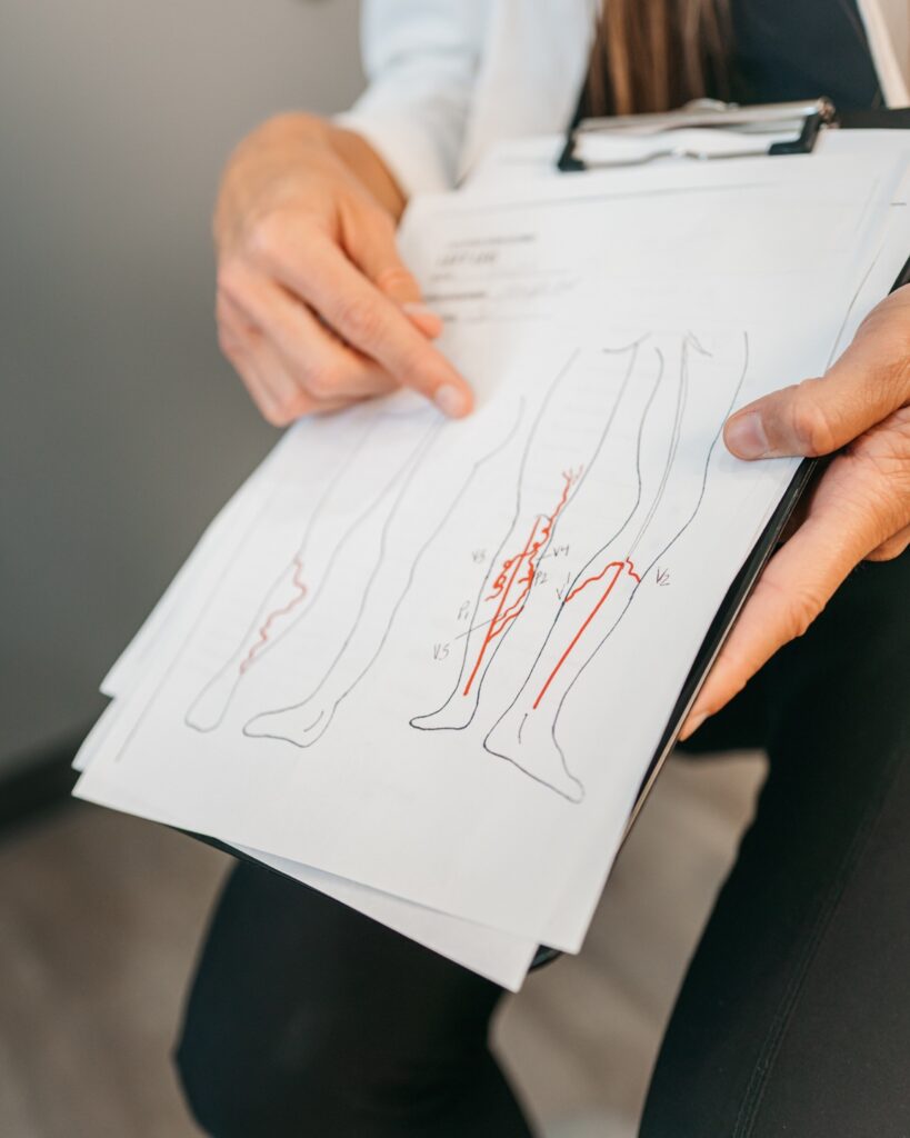 a vein mapping explained by a vein doctor from Gilvydis Vein Clinic