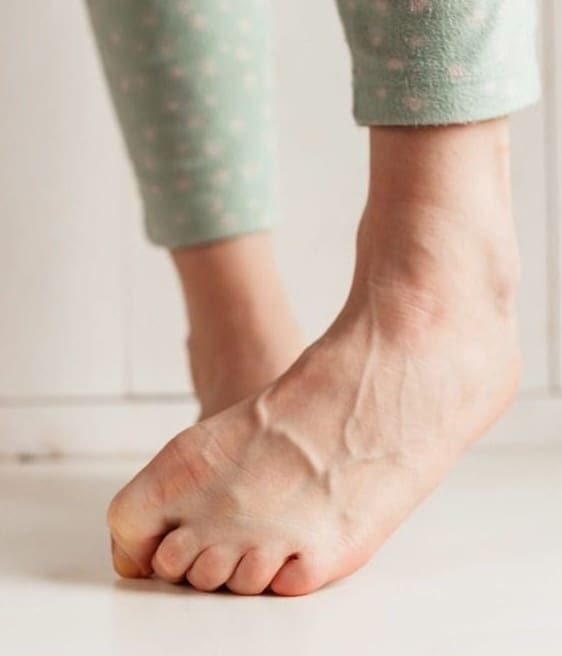 Veins popping out from feet and legs