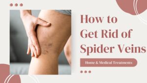 how to get rid of spider veins with medical and home remedies