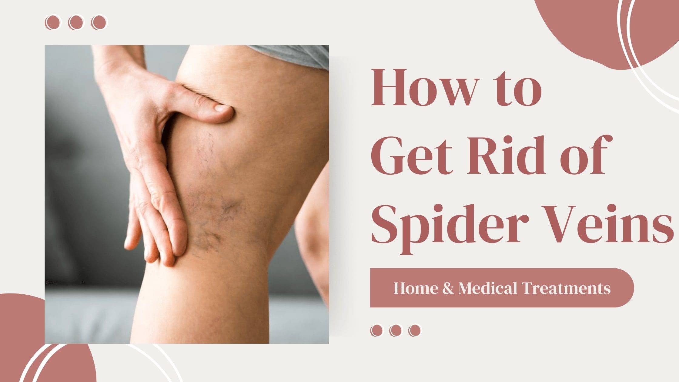 Read more about the article How To Get Rid of Spider Veins