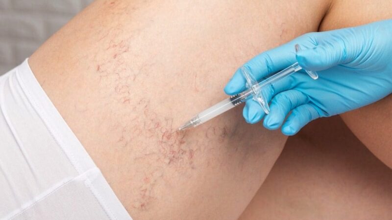 Sclerotherapy vein treatment