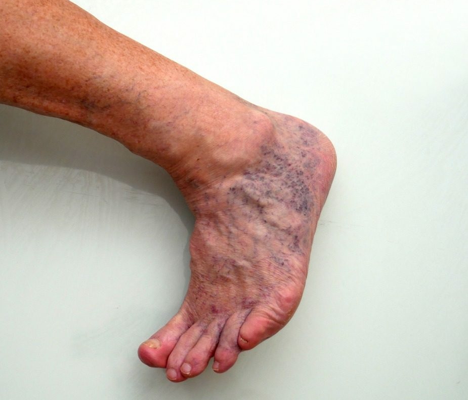 spider veins and skin discoloration