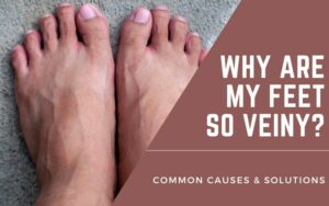 why are my feet so veiny - veiny feet cause and solution