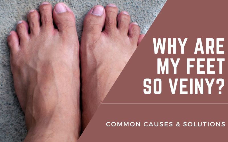 Read more about the article Veiny Feet: Everything You Need To Know
